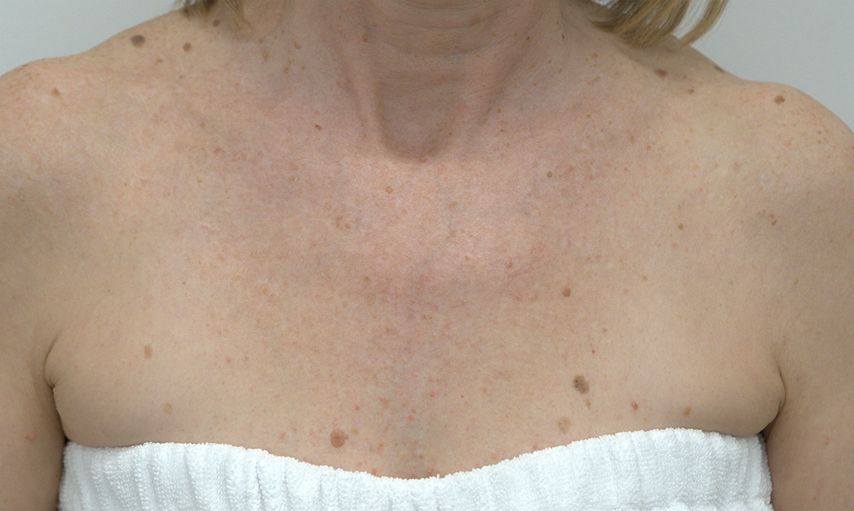 After BBL, chest sun damage improvement