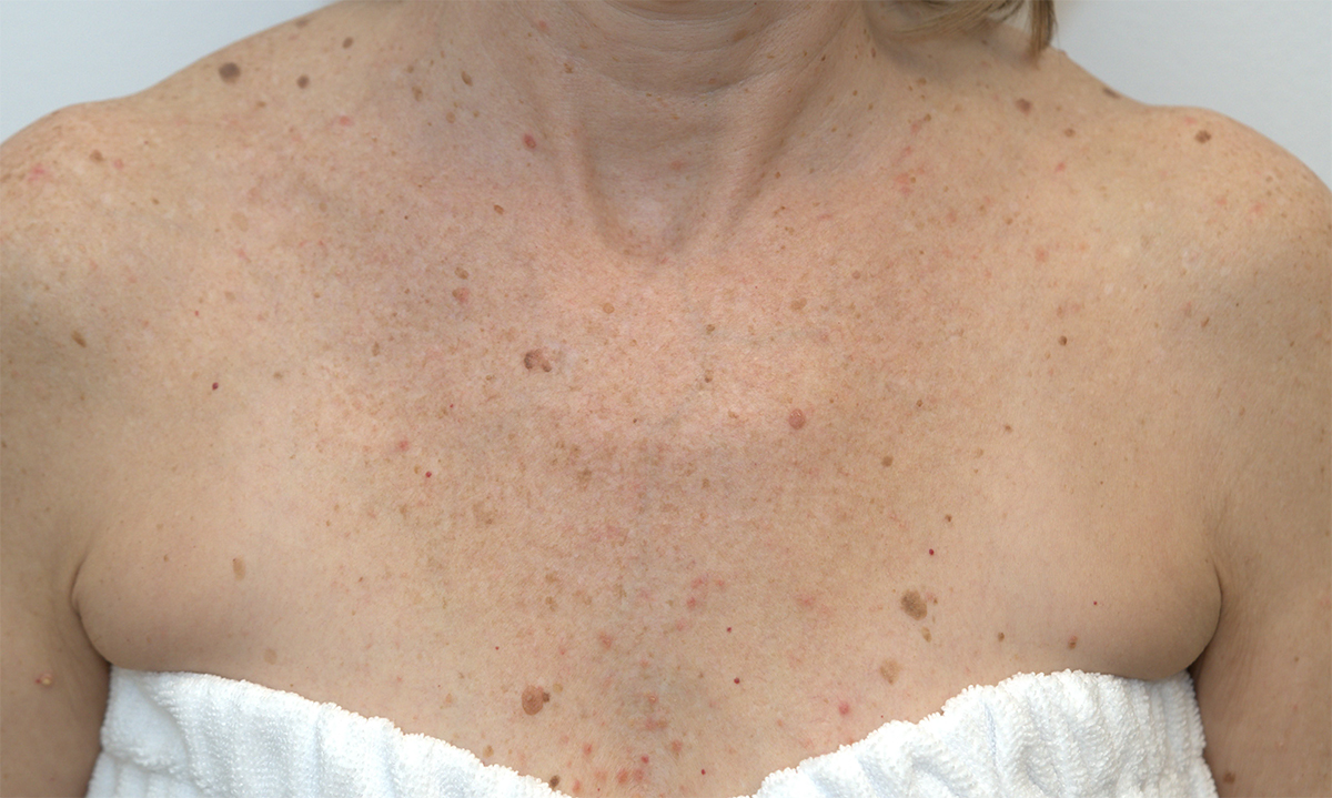 Before BBL, chest sun damage