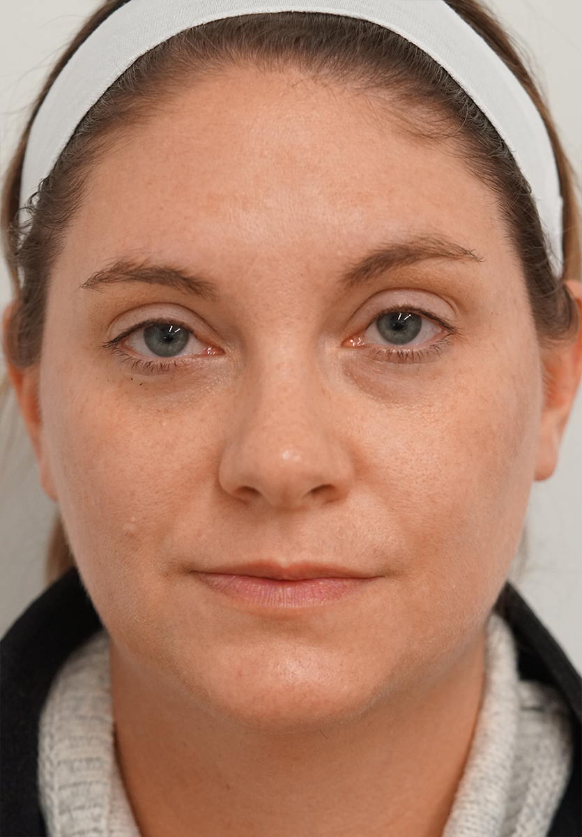 After BBL, clearer skin tone