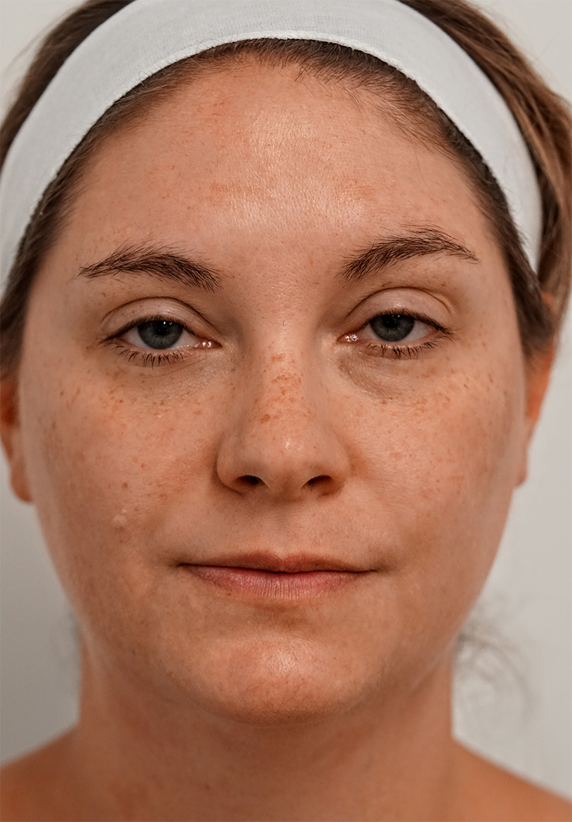 Before BBL, brown spots and freckles
