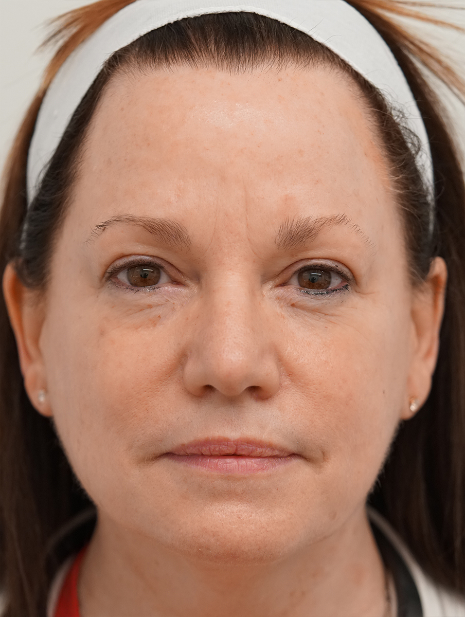 After BBL, improved skin tone