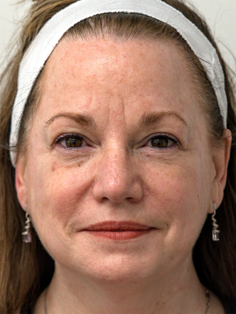 Before BBL, rosacea and redness