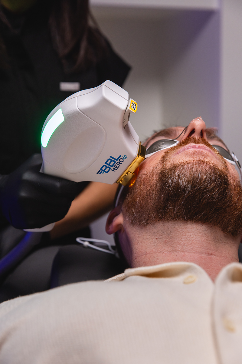 BBL Heroic BroadBand Light treatment