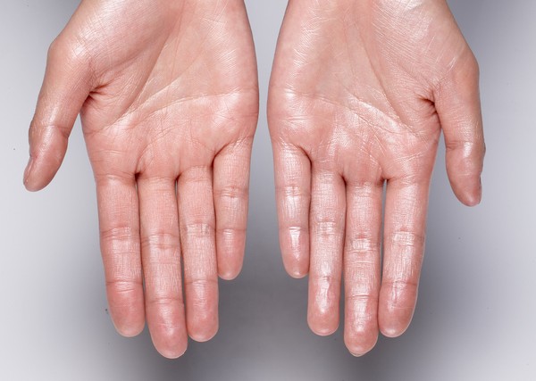 Palmar hyperhidrosis, excessive hand sweating
