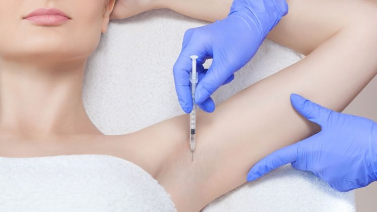 Botox for sweating treatment