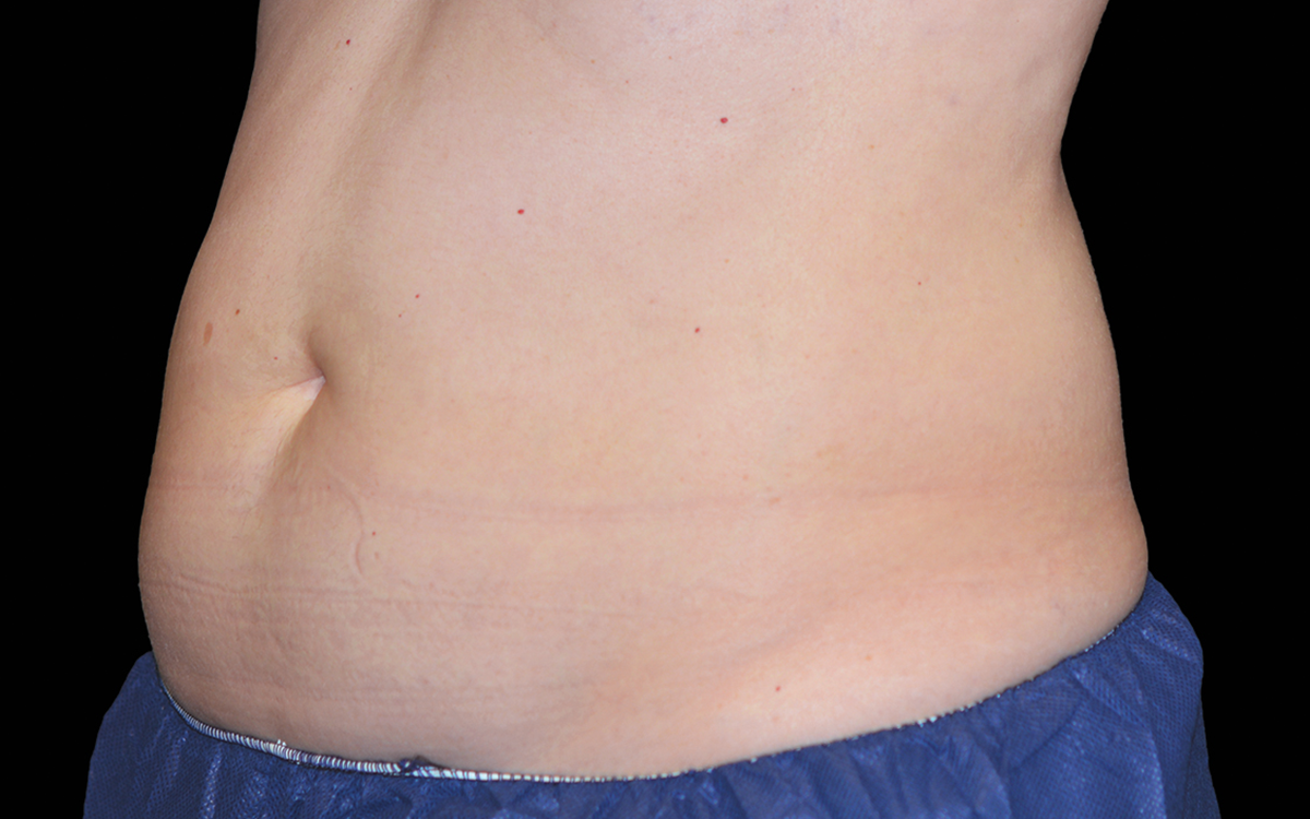 After CoolSculpting abdomen