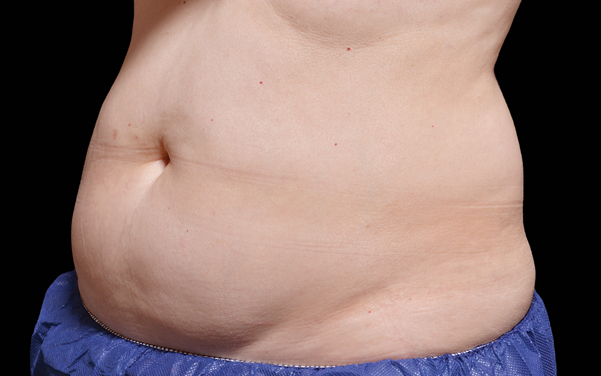 Before CoolSculpting abdomen