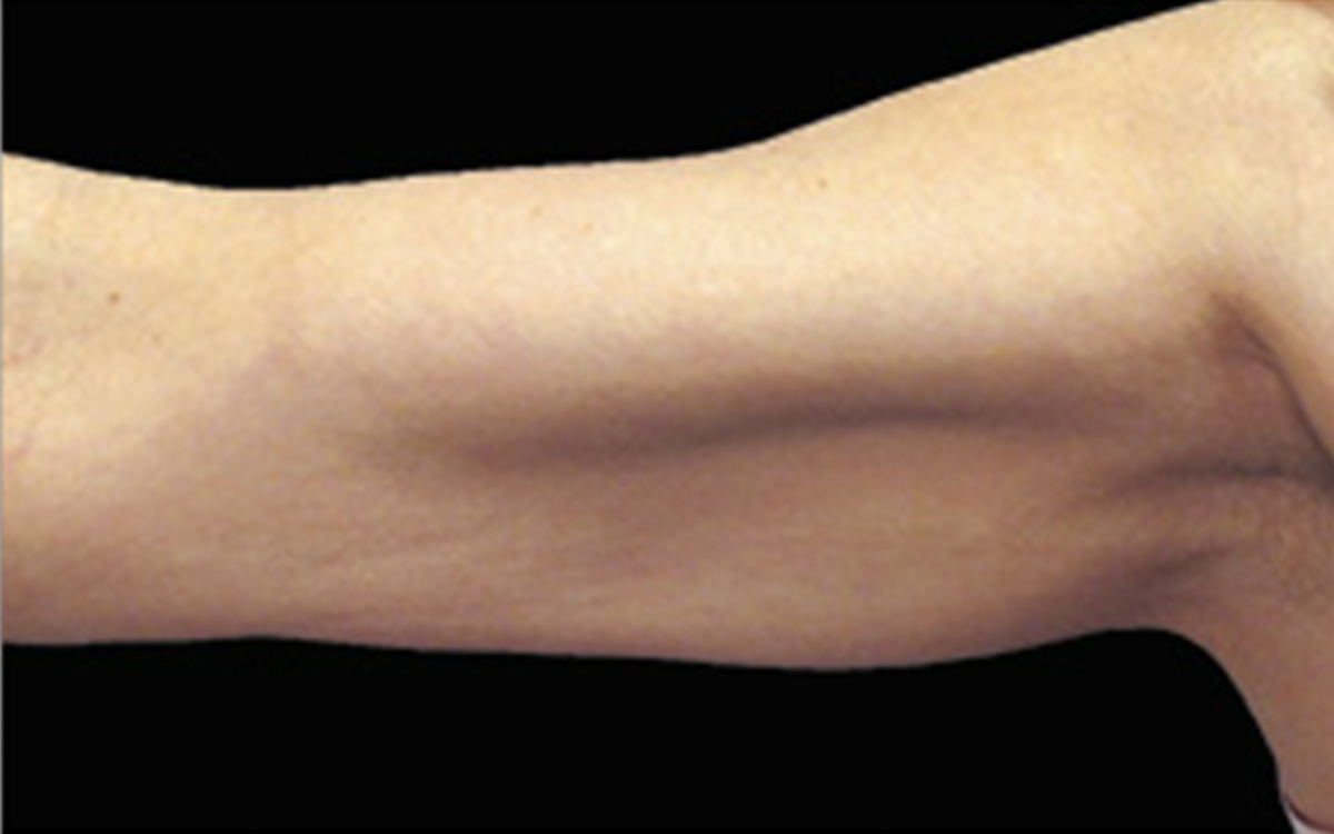 After CoolSculpting arms