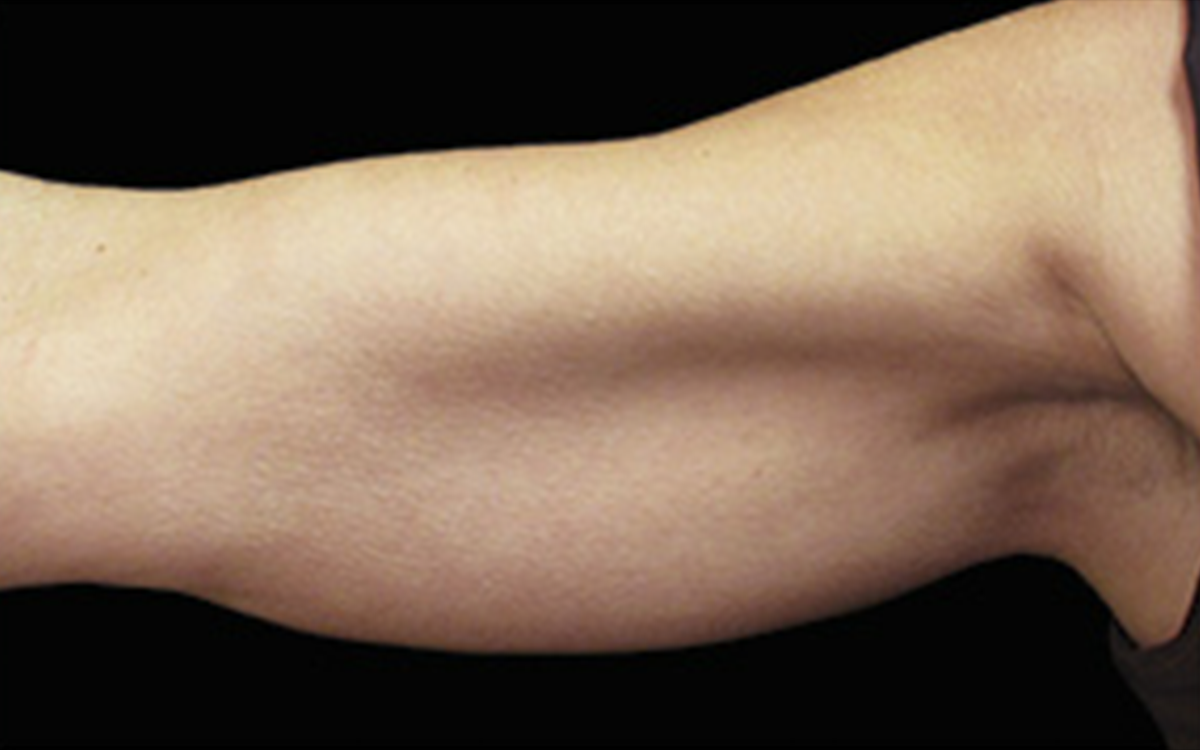 Before CoolSculpting arms