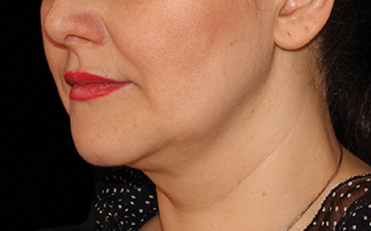 After CoolSculpting chin