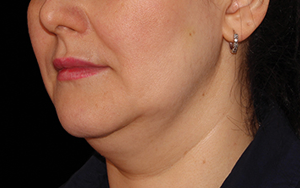 Before CoolSculpting chin