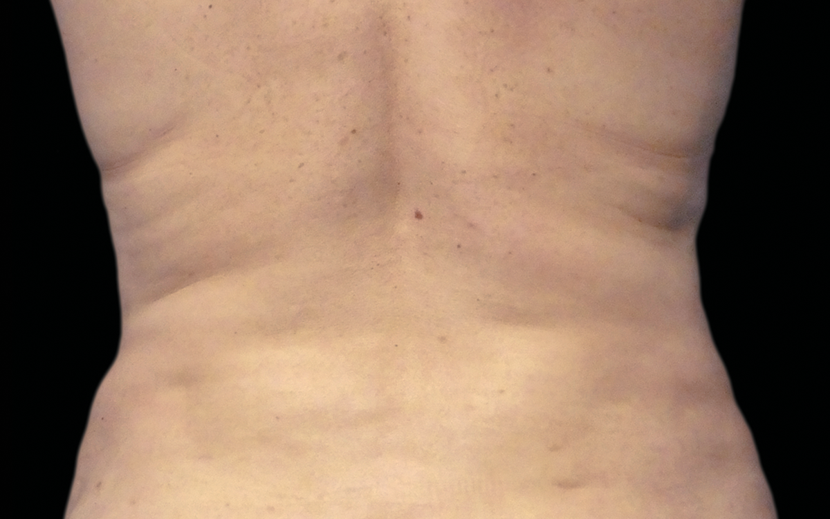 After CoolSculpting flanks