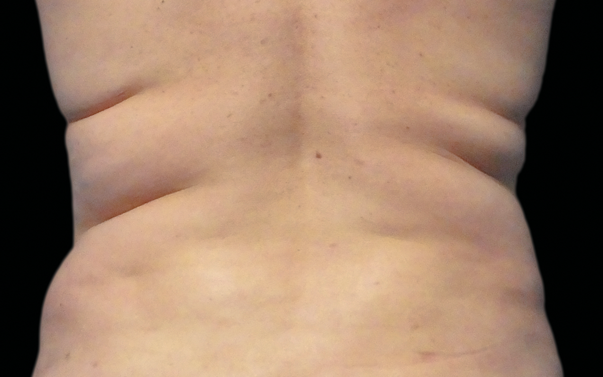 Before CoolSculpting flanks