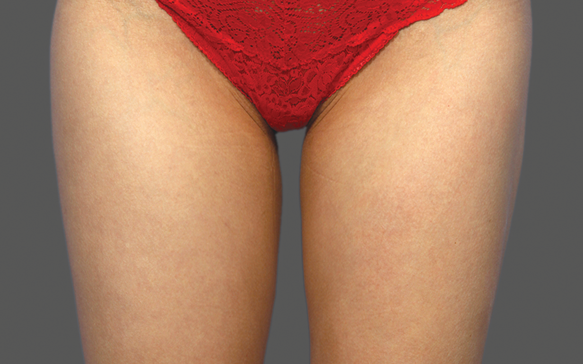 After CoolSculpting inner thighs