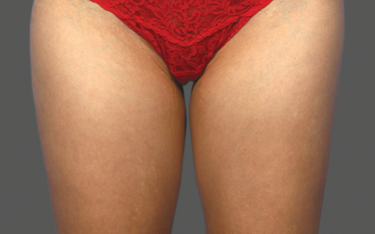 Before CoolSculpting inner thighs