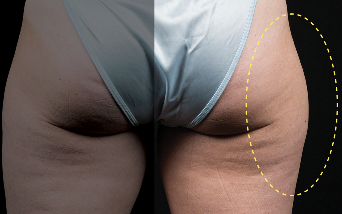 Before CoolSculpting outer thighs