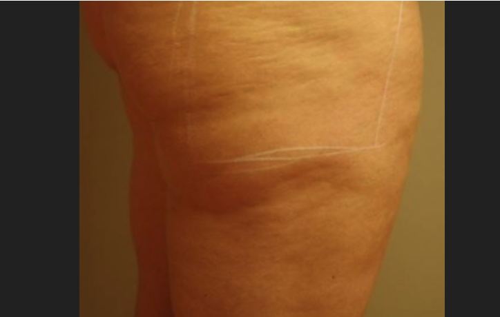 Before Halo Laser, sun damage and pigmentation