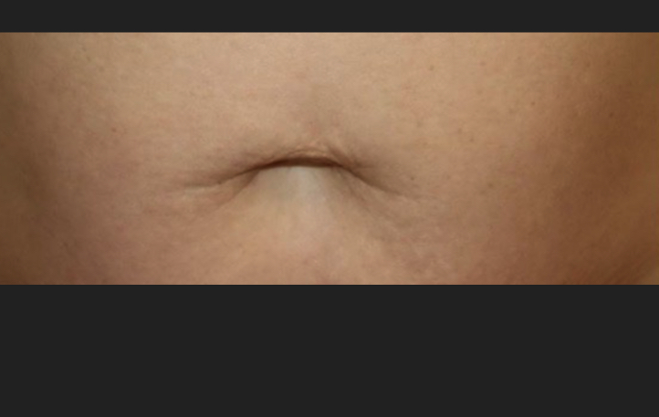 After Halo Laser, smoother skin texture