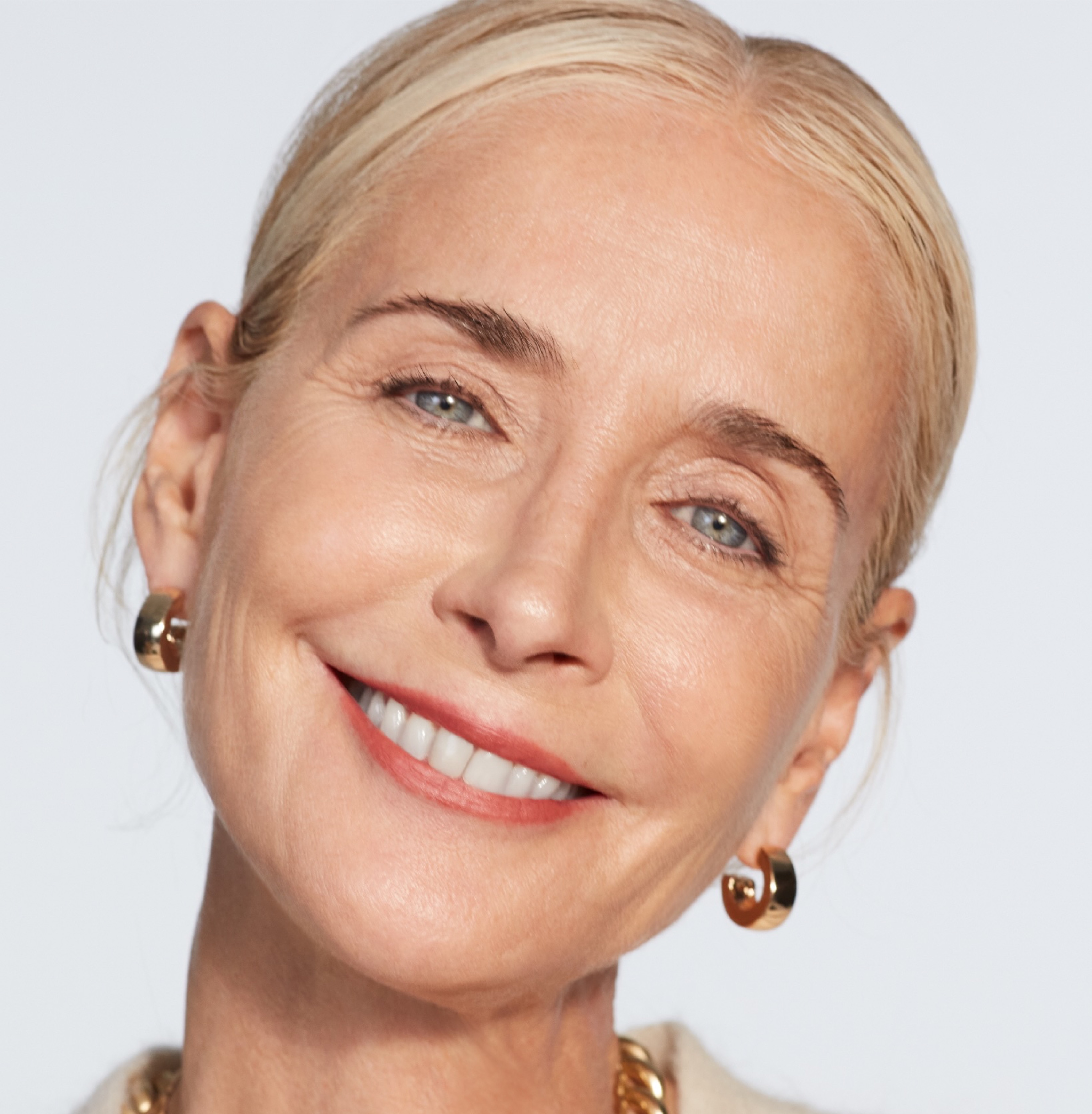 Juvéderm Vollure XC, nasolabial folds and marionette lines