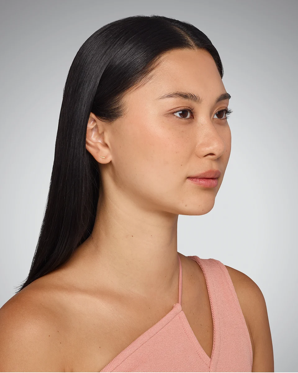 Before Volbella, lip profile improvement