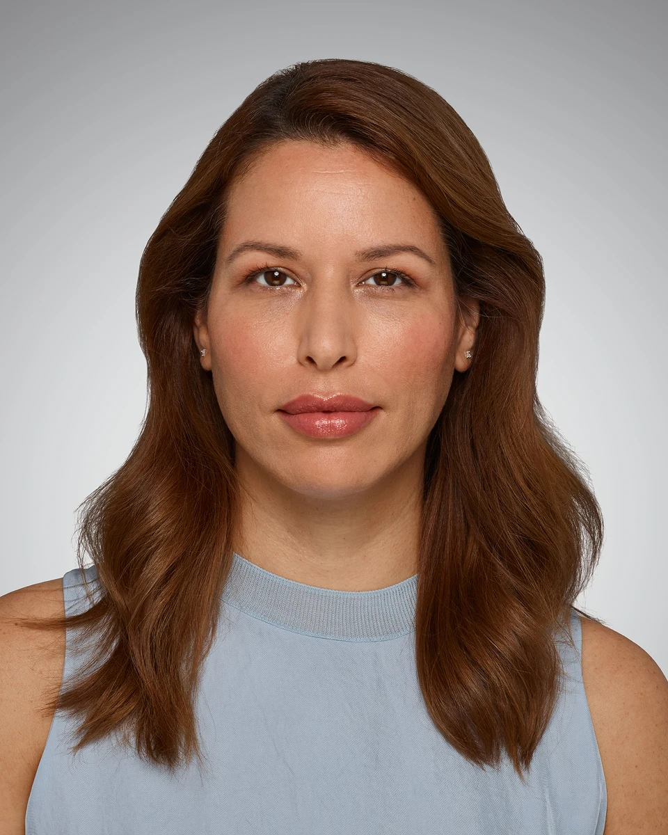 After Vollure, smoothed smile lines