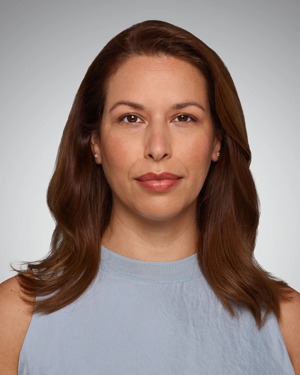 Before Vollure, nasolabial fold close-up