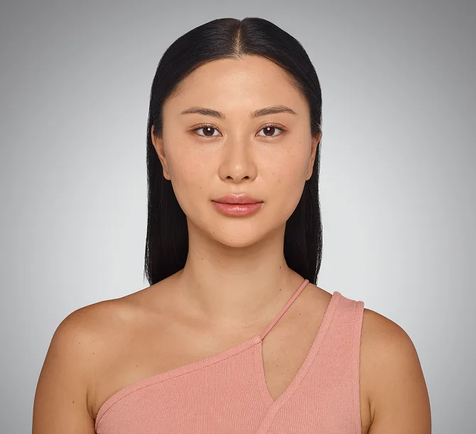 After Vollure nasolabial fold treatment