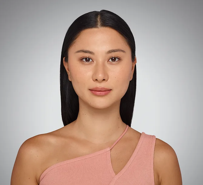 Before Vollure nasolabial fold treatment