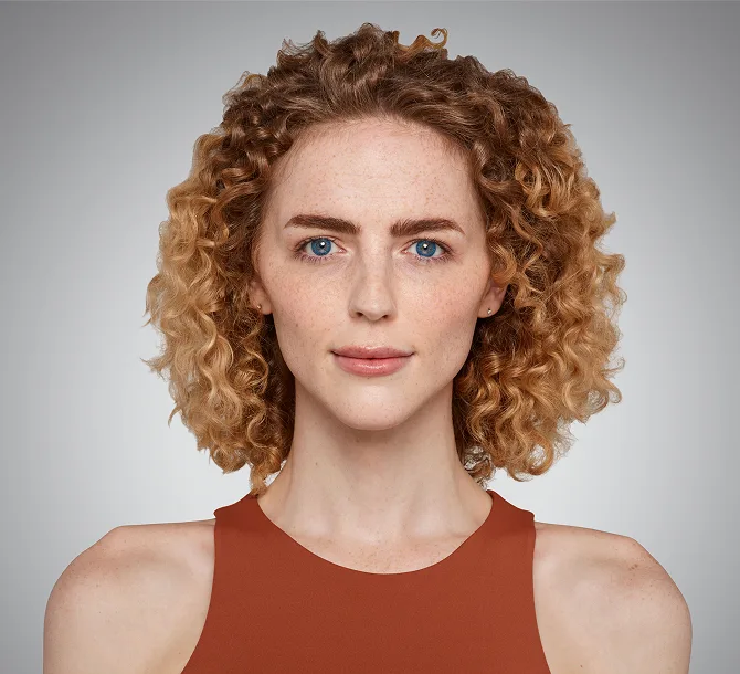 After Voluma cheek filler