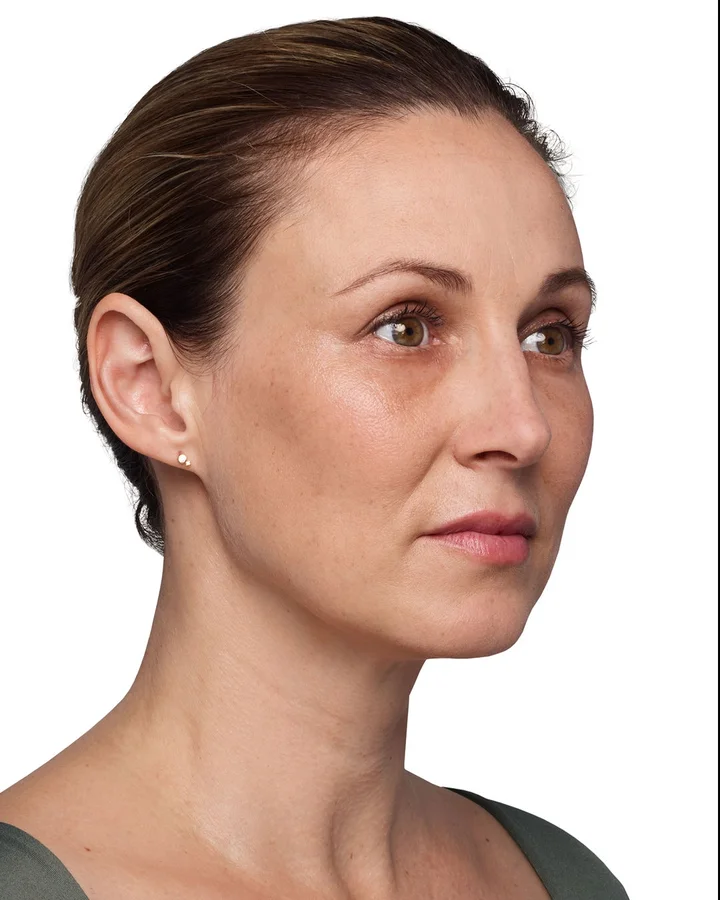 After Voluma, 1 syringe cheek lift