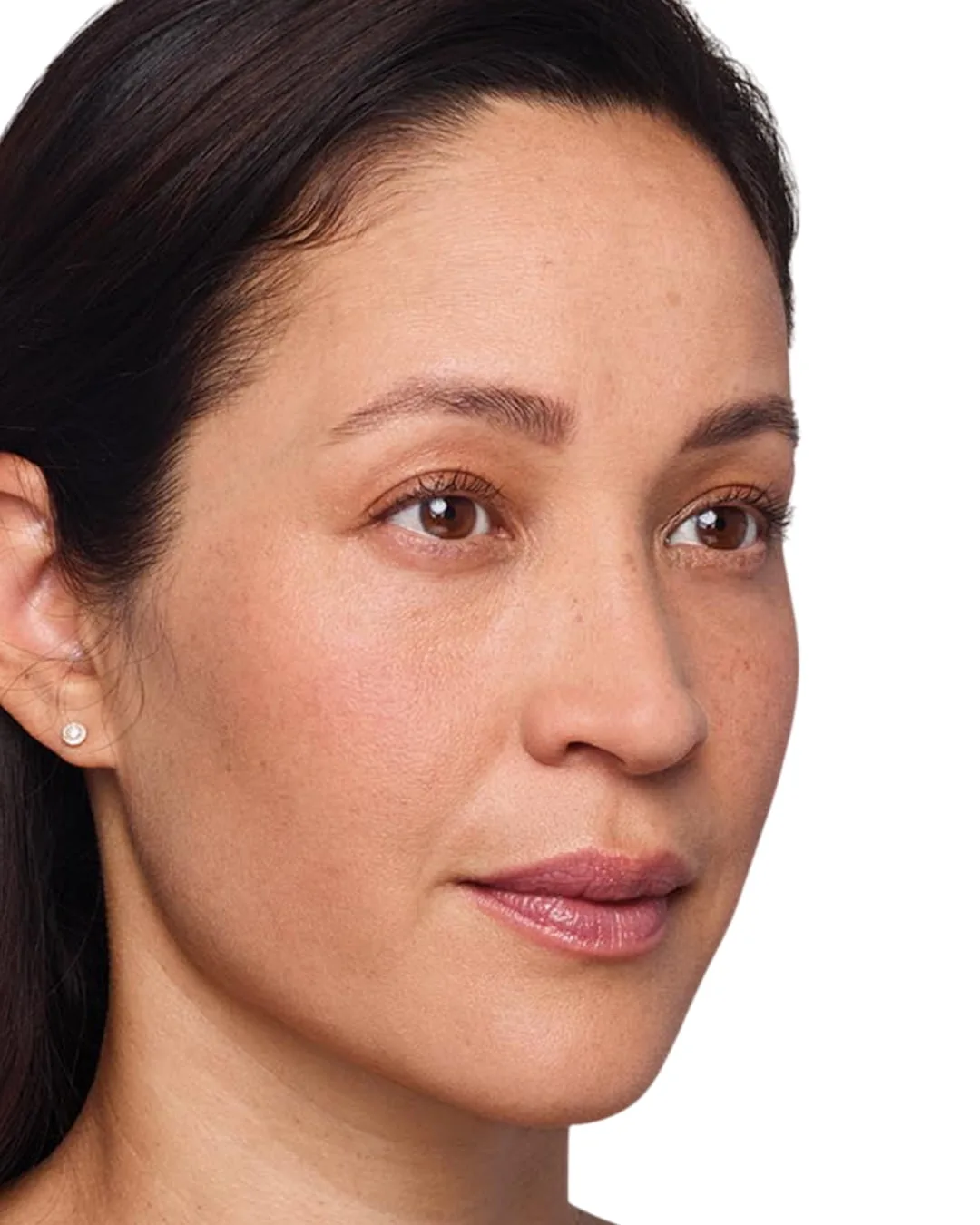 After Voluma, restored cheek volume