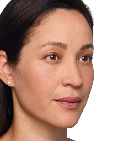 Before Voluma cheek filler