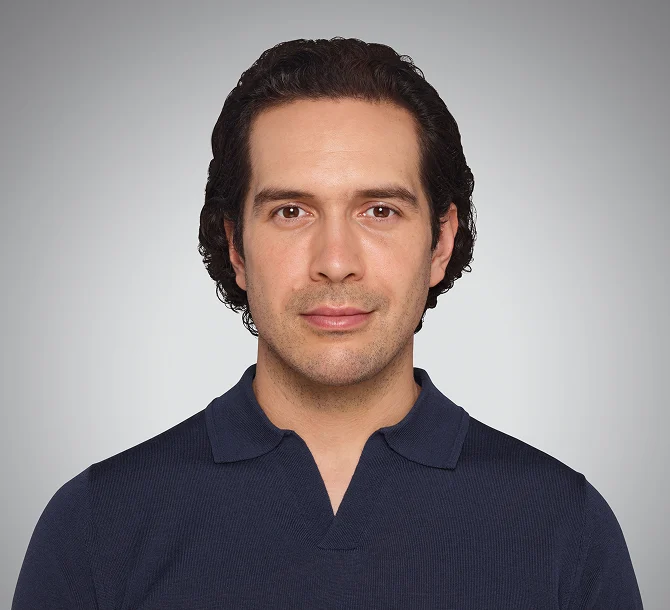 After Volux jawline filler