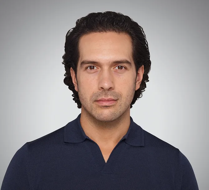 Before Volux jawline filler