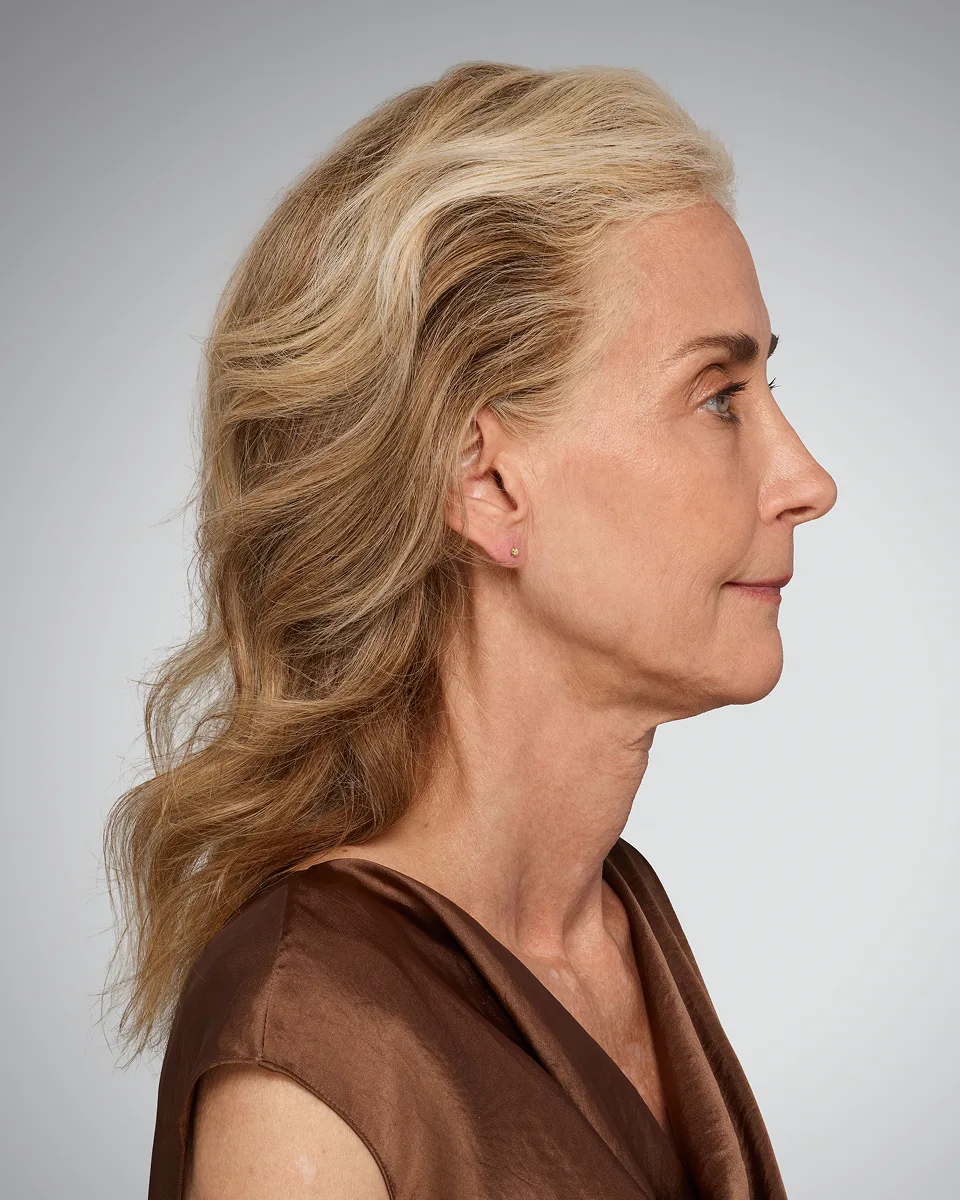 Before Volux, soft jawline profile