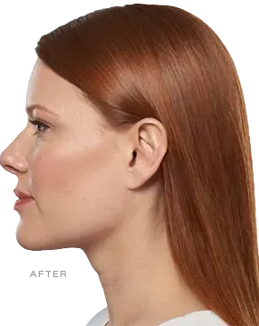 After Kybella, submental reduction