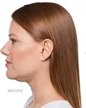 Before Kybella, mild double chin