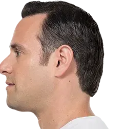 After Kybella, defined chin profile