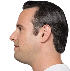 Before Kybella, moderate submental fat