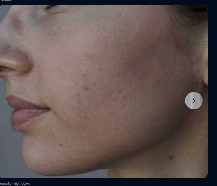 After microneedling, acne scars improved