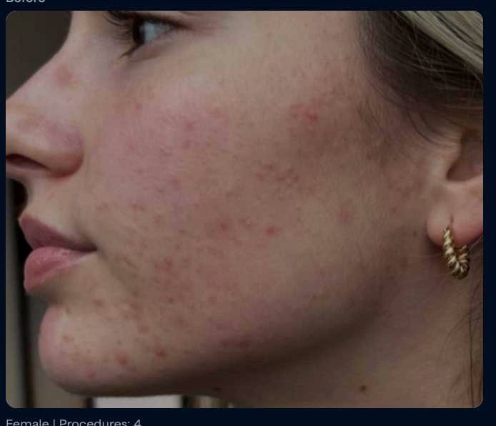 Before microneedling, acne scars