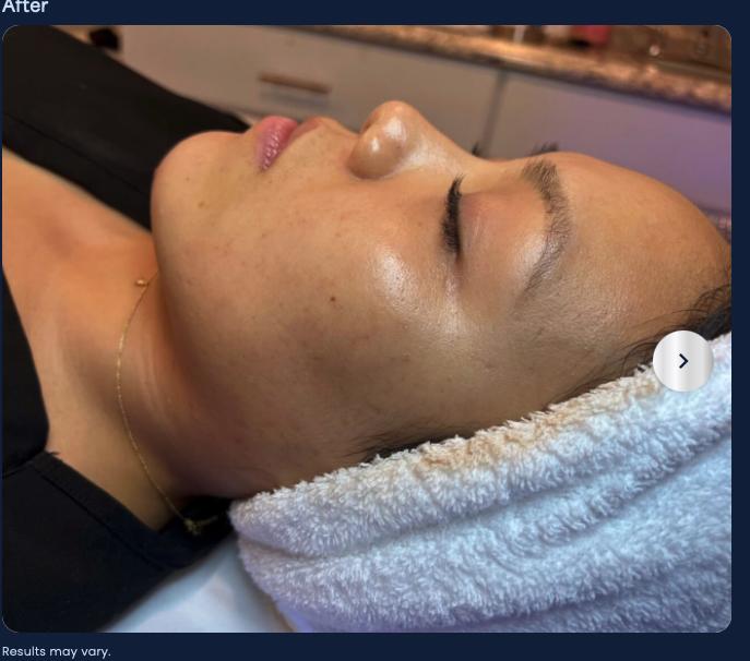 After microneedling, firmer skin