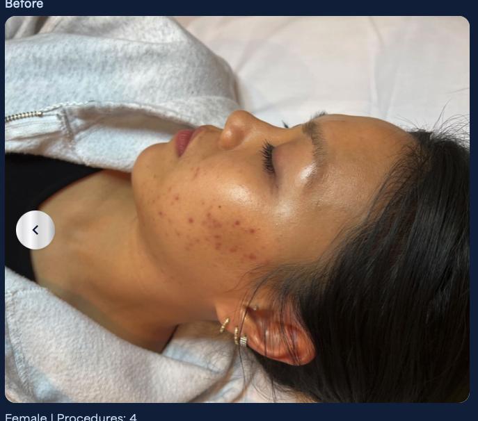 Before microneedling, skin laxity