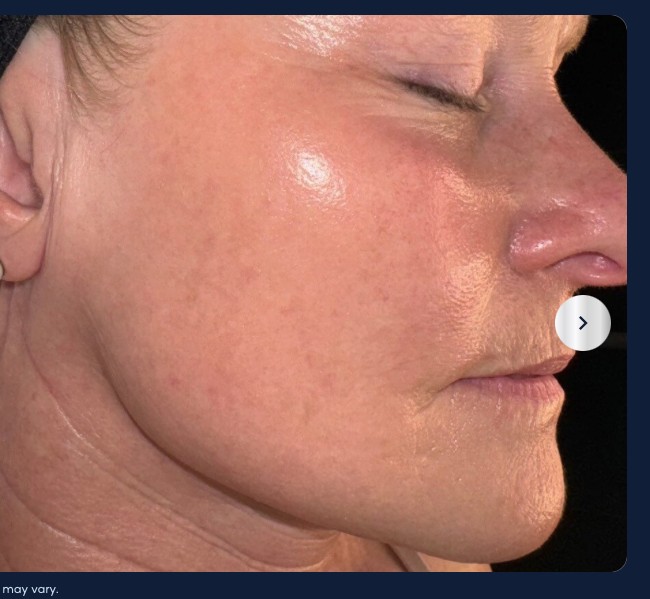 After microneedling, refined pores