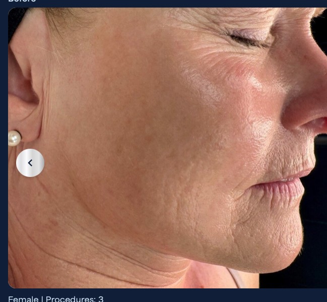 Before microneedling, pores and texture