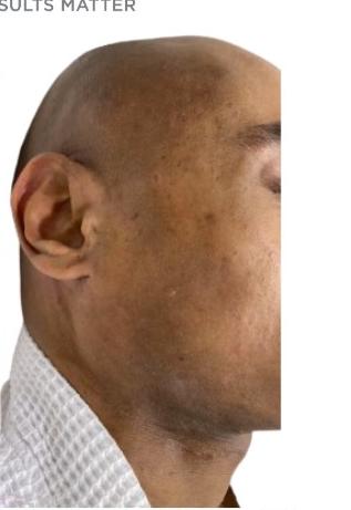 After MOXI, clearer skin