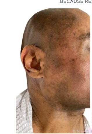 Before MOXI, pigmentation and texture