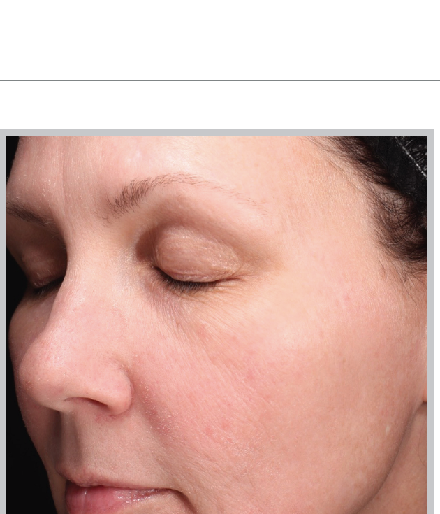 After MOXI, improved skin tone