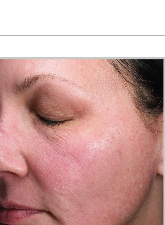 Before MOXI, redness and uneven tone