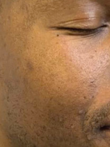 After MOXI, improved skin texture